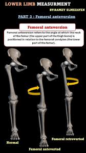 Image result for Femoral Retroversion
