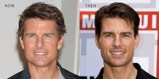 If you're not happy with the b. The Plastic Surgery Clinic Celeb Then Now Ft Tom Cruise The General Narrative When Discussing The Popularity Of Botox And Fillers In Hollywood Tends To Emphasize Female Celebrities Well Word