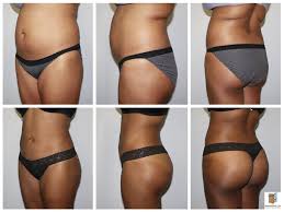 It is very difficult to talk about the cost of such an effective procedure. Brazilian Butt Lift 360 Lipo Mansfield Arlington Dallas Ft Worth