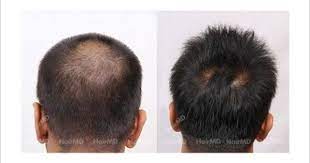 Male Hair Loss At Back Of Scalp Before And After Results Hair Loss Men Hair Loss Pictures Hair Loss