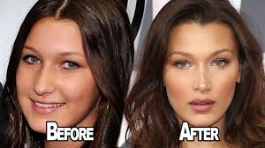 The cat perfectly fine it can. Bella Hadid Opens Up About Having Plastic Surgery Youtube