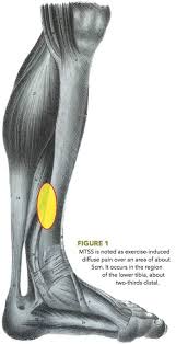 Image result for Tibia Stress Fracture