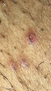Genital warts, also called condyloma accuminata or venereal warts, are symptoms of a highly contagious sexually transmitted disease caused by certain types of human. Is This Herpes Genital Herpes Simplex Forums Patient