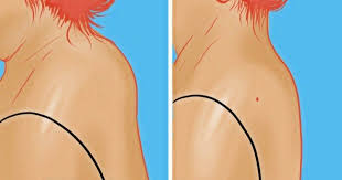 как избавиться от горба на спине в домашних условиях Vsego Odno Uprazhnenie Raz I Navsegda Izbavit Ot Nekrasivoj Holki Na Spine Uprazhneniya Zdorove Zdorovoe Pohudenie