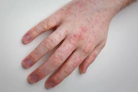 Image result for dermatitis contacta