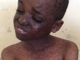 Xeroderma pigmentosum (xp) is a rare genetic disorder that occurs worldwide in all races and ethnic groups. Xeroderma Pigmentosum Images Dermnet Nz