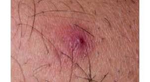 Having an ingrown hair can be painful, but they're usually no cause for concern. Ingrownhairprevention Ingrown Leg Hair Ingrown Hair Bump Hairstyles