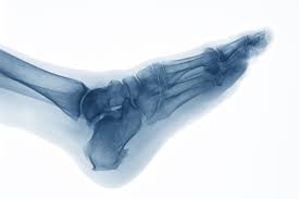 Maybe you would like to learn more about one of these? What Causes Bone Spurs
