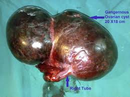 Check spelling or type a new query. Torsion Of Huge Dermoid Cyst In Adolescent Girl A Case Report Sciencedirect