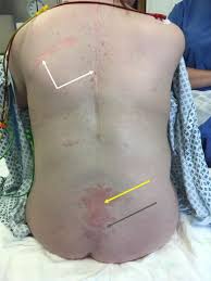 Image result for Spinal Dysraphism