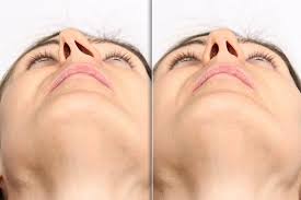 Septoplasty