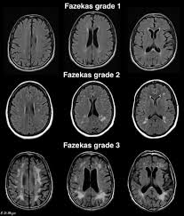 Fazekas Scale For White Matter Lesions Radiology Reference Article Radiopaedia Org