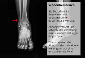 Wadenbeinbruch Wann Kann Man Das Bein Wieder Voll Belasten