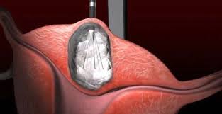 We did not find results for: Melting Tumors Is New Option For Women With Uterine Fibroids Health Stltoday Com