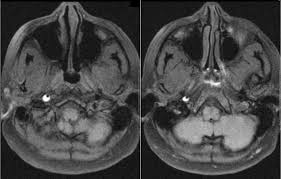 Spontaneous dissection of the carotid artery occurs in 3 per 100,000 of the population annually (1). Carotid Artery Dissection 7