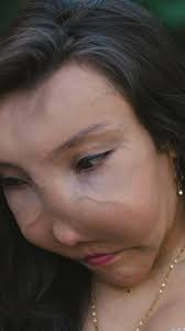 My facial deformity won't define me 💪 #fbreels #fibrousdysplasia  #borndifferent #facialdifference #selflove