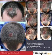 Revita shampoo is formulated to maintain scalp vitality and act against follicular dysfunction, achieving the best results in a short period of time. Results Revita Shampoo Shampoo Revita