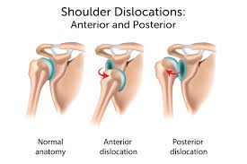 Specifically, the four rotator cuff muscles include the following Shoulder Dislocation Boston Children S Hospital