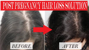 When does postpartum hair loss stop? How To Stop Hair Fall After Pregnancy Post Pregnancy Hair Loss Prevention Youtube
