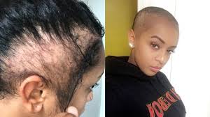 My Hairstyle Made Me Go Bald Pattern Baldness Male Pattern Baldness Alopecia Hairstyles