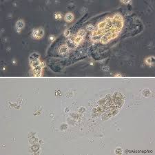 Cast With Tubular Epithelial Cells In A Patient With Aki Phase Contrast Bright Fie Medical Laboratory Scientist Medical Laboratory Science Medical Laboratory