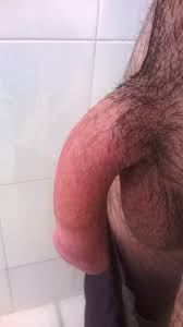 بیماری پیرونی شایعترین علت کجی آلت تناسلی مردان+ عکس - دکتر حسین کرمی متخصص  ارولوژی