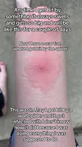Image result for wolf spider bite skin
