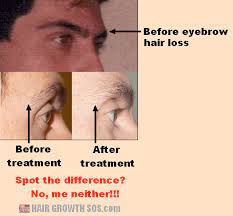 In most cases, your hair will grow back when. What Causes Eyebrow Hair Loss How Do You Treat It