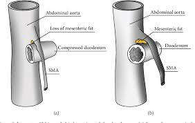 Figure 1 From Superior Mesenteric Artery Syndrome Associated With Rapid Weight Loss Attributed To Amphetamine Abuse Semantic Scholar