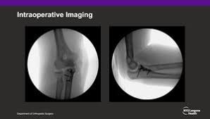 Image result for Coronoid Process Fracture