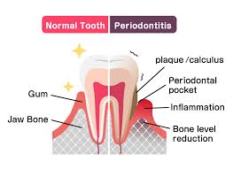 Image result for Periodontitis