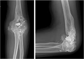 Image result for Elbow XRay