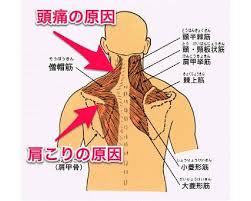 データ 体 おしゃれまとめの人気アイデア pinterest rayla 背中の痛み 痛み 肩こり