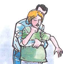 Karına bası uygulanır (heimlich manevrası). Ilk Yardim 12 Heimlich Manevrasi Dargeb