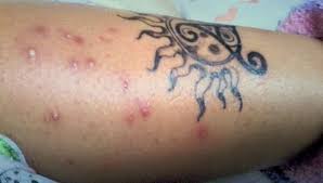 Any sign of pink to red coloration around the tattoo site indicates inflammation. 5 Causes Of Tattoo Pimples And How To Get Rid Of Tattoo Pimples Fast