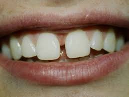 Some people are blessed enough to have sparkling teeth naturally, but most of people have to live with the imperfections in their teeth, but not anymore. Tooth Gaps Tender Care Dental