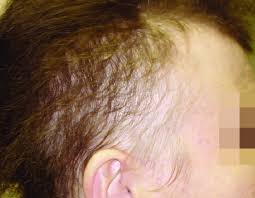 Anagen effluvium is the abnormal diffuse loss of hair during the growth phase caused by an event that impairs the mitotic activity of the hair follicle, most commonly chemotherapy. Alopecia Areata In The Diffuse Form In General There Is No Central Download Scientific Diagram