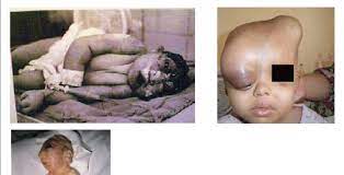 The first uranium processed by canada was used to produce nuclear explosives for the atomic bombs dropped at hiroshima and nagasaki in 1945. The Effects Of Depleted Uranium Children Affected By Radiation And Download Scientific Diagram