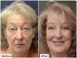 Plastic Surgery in Colombia