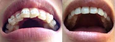 May 09, 2021 · don't let the cost of braces stop you from getting them for yourself or a family member. Adult Braces My Experience And How I Saved Over 2 000