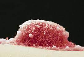 Cancer often takes years, even decades, to develop after a person gets hpv. Cervical Cancer Symptoms Stages And Treatment