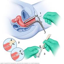See full list on mayoclinic.org Cervical Cancer Diagnosis And Treatment Mayo Clinic