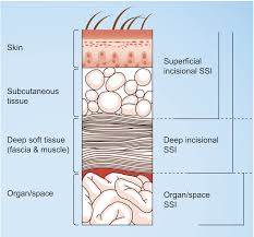 classification of surgical site infections according to cdc