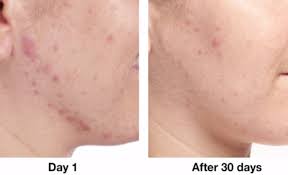 Fine hair, meet your match! Acne Solutions Clinical Clearing Gel Clinique Sephora