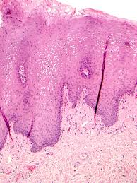 Image result for Leukoedema