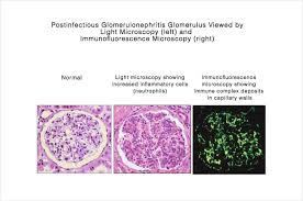 What are the signs and symptoms of iga nephropathy? Post Infectious Glomerulonephritis Gn Unc Kidney Center