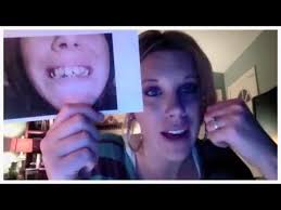 Check spelling or type a new query. Before And After Dentures Youtube