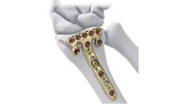 2.4mm Variable Angle Distal Radius Volar Plate | J&J Medical ...