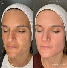 melasma × summer × hydroquinone a 5 month ONLY skincare transformation  summer is around the corner, which means heat and sun exposure — two of the  main contributors to melasma. i love