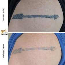 Why does tattoo ink fade over time? 2 Treatments And This Tattoo Has Had Massive Fading Note How Much Of The Shading Has Faded Lining Always Take A Bit Tattoos Brown Tattoo Ink Red Ink Tattoos